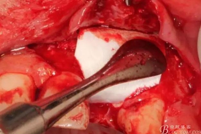 一例上前牙種植失敗病例的補(bǔ)救 一例上前牙種植失敗病例的補(bǔ)救