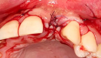 一例上前牙種植失敗病例的補(bǔ)救 一例上前牙種植失敗病例的補(bǔ)救
