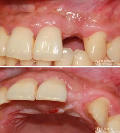 一例上前牙種植失敗病例的補(bǔ)救 一例上前牙種植失敗病例的補(bǔ)救