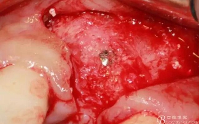 一例上前牙種植失敗病例的補(bǔ)救 一例上前牙種植失敗病例的補(bǔ)救