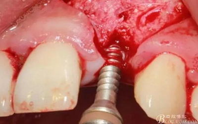 一例上前牙種植失敗病例的補(bǔ)救 一例上前牙種植失敗病例的補(bǔ)救