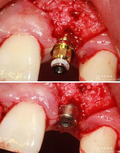 一例上前牙種植失敗病例的補(bǔ)救 一例上前牙種植失敗病例的補(bǔ)救