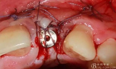 一例上前牙種植失敗病例的補(bǔ)救 一例上前牙種植失敗病例的補(bǔ)救