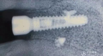 一例上前牙種植失敗病例的補(bǔ)救 一例上前牙種植失敗病例的補(bǔ)救