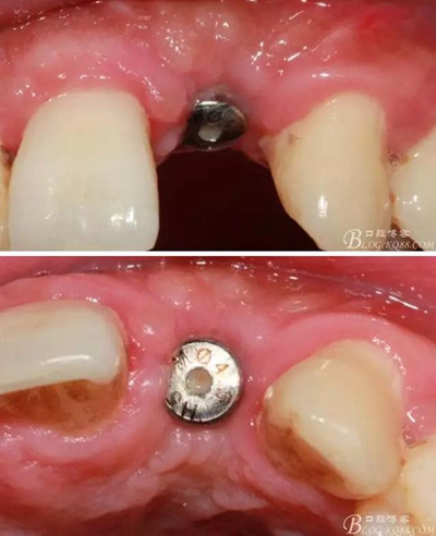 一例上前牙種植失敗病例的補(bǔ)救 一例上前牙種植失敗病例的補(bǔ)救