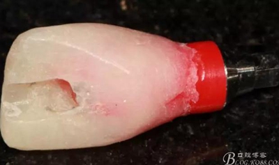 一例上前牙種植失敗病例的補(bǔ)救 一例上前牙種植失敗病例的補(bǔ)救