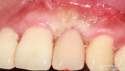 一例上前牙種植失敗病例的補(bǔ)救 一例上前牙種植失敗病例的補(bǔ)救