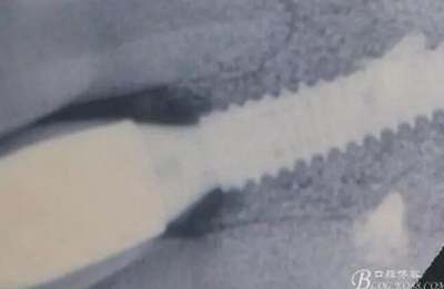 一例上前牙種植失敗病例的補(bǔ)救 一例上前牙種植失敗病例的補(bǔ)救