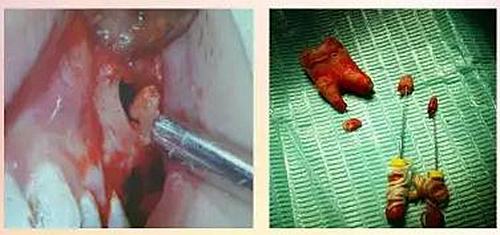 拔牙斷根的去與留？