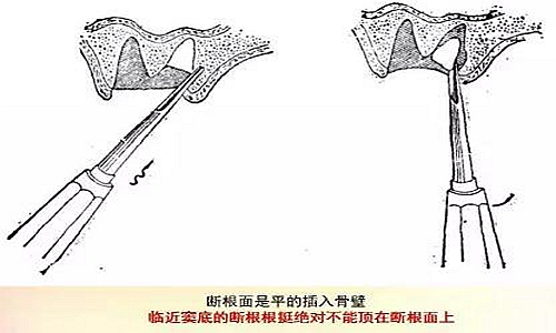 拔牙斷根的去與留？