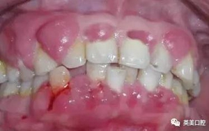 艾滋病早期重要癥狀:口腔的各種表現(xiàn) 艾滋病早期重要癥狀:口腔的各種表現(xiàn)