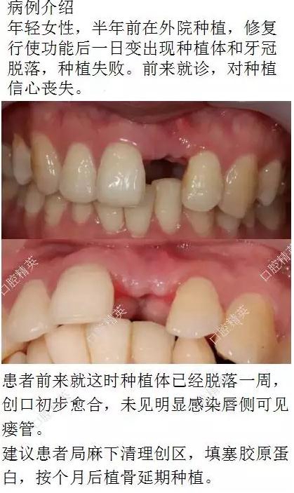 種植失敗的骨增量處理一例 種植失敗的骨增量處理一例