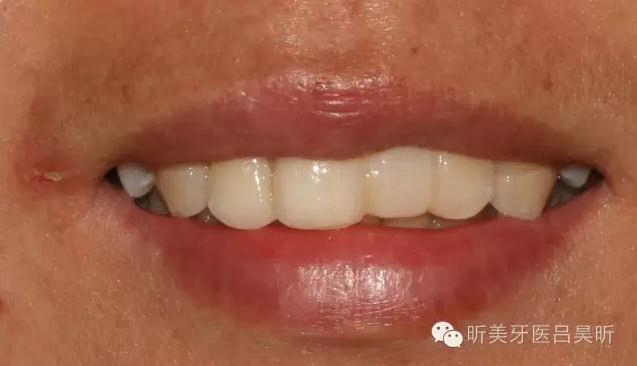 種植失敗的骨增量處理一例 種植失敗的骨增量處理一例