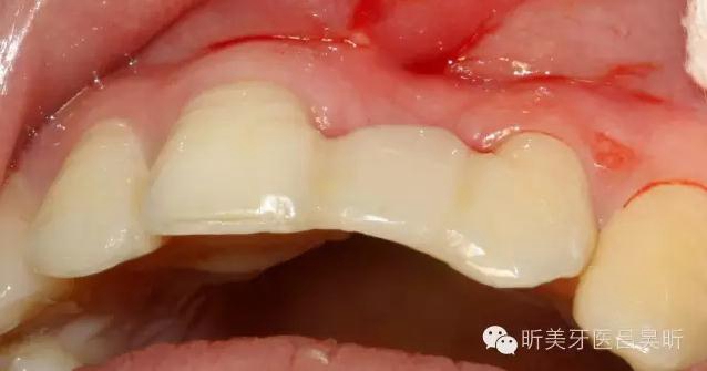 種植失敗的骨增量處理一例 種植失敗的骨增量處理一例