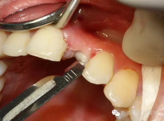 種植失敗的骨增量處理一例 種植失敗的骨增量處理一例