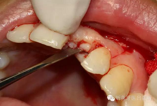 種植失敗的骨增量處理一例 種植失敗的骨增量處理一例