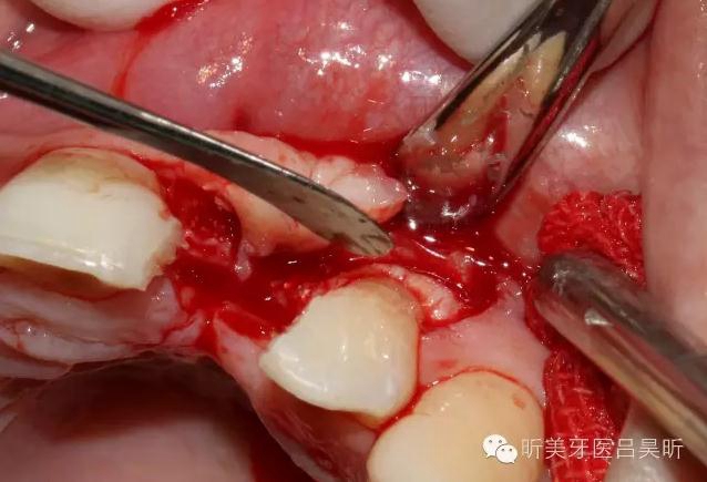 種植失敗的骨增量處理一例 種植失敗的骨增量處理一例