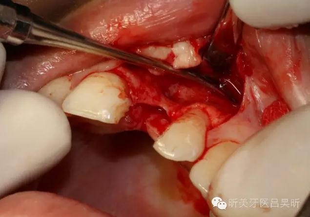 種植失敗的骨增量處理一例 種植失敗的骨增量處理一例