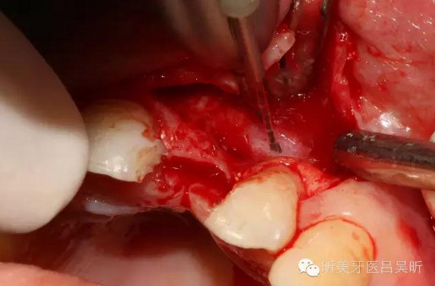 種植失敗的骨增量處理一例 種植失敗的骨增量處理一例