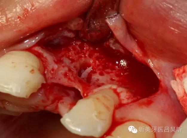 種植失敗的骨增量處理一例 種植失敗的骨增量處理一例