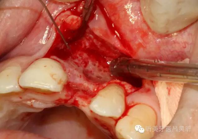 種植失敗的骨增量處理一例 種植失敗的骨增量處理一例