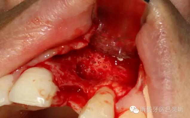 種植失敗的骨增量處理一例 種植失敗的骨增量處理一例