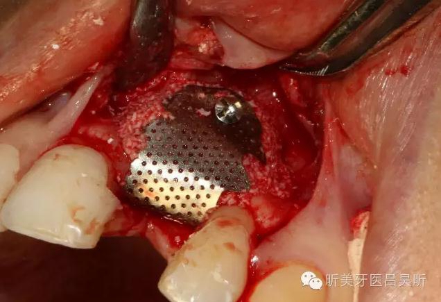 種植失敗的骨增量處理一例 種植失敗的骨增量處理一例