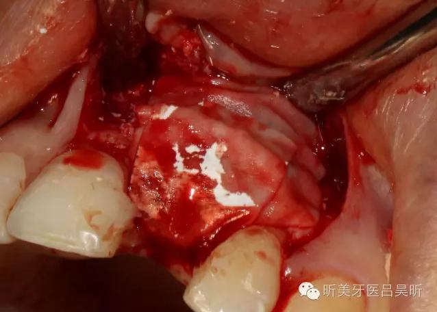 種植失敗的骨增量處理一例 種植失敗的骨增量處理一例