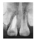 【病例分享】年輕恒牙伴牙根內吸收根尖誘導成形術一例 【病例分享】年輕恒牙伴牙根內吸收根尖誘導成形術一例