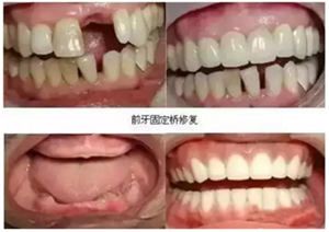 一位資深牙醫(yī)的總結(jié) | 如何減輕患者鑲牙后酸痛癥狀的措施！