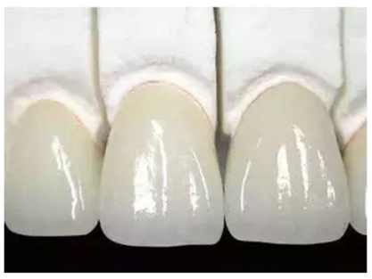 一位資深牙醫(yī)的總結(jié) | 如何減輕患者鑲牙后酸痛癥狀的措施！