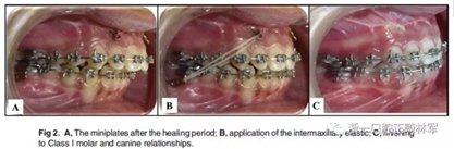 正畸矯正 正畸矯正