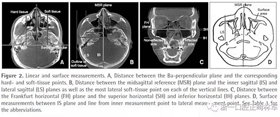 正畸文獻(xiàn)閱讀--無(wú)癥狀單側(cè)唇腭裂患者面中部不對(duì)稱的三維分析 正畸文獻(xiàn)閱讀--無(wú)癥狀單側(cè)唇腭裂患者面中部不對(duì)稱的三維分析