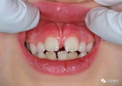 【案例】口腔激光輔助兒童口腔系帶整形概述在兒童口腔治療中，最大的挑戰(zhàn)就是兒童對(duì)疼痛、治療器械、噪聲以及其他所有陌生事物的恐懼心理。