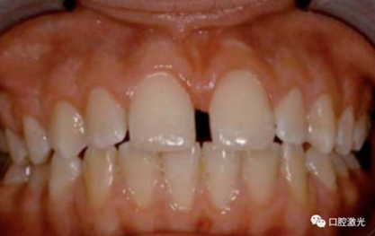 【案例】口腔激光輔助兒童口腔系帶整形概述在兒童口腔治療中，最大的挑戰(zhàn)就是兒童對(duì)疼痛、治療器械、噪聲以及其他所有陌生事物的恐懼心理。