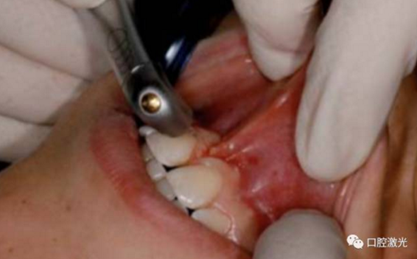 【案例】口腔激光輔助兒童口腔系帶整形概述在兒童口腔治療中，最大的挑戰(zhàn)就是兒童對(duì)疼痛、治療器械、噪聲以及其他所有陌生事物的恐懼心理。