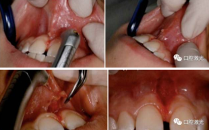 【案例】口腔激光輔助兒童口腔系帶整形概述在兒童口腔治療中，最大的挑戰(zhàn)就是兒童對(duì)疼痛、治療器械、噪聲以及其他所有陌生事物的恐懼心理。