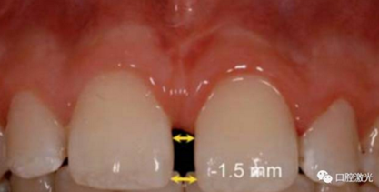 【案例】口腔激光輔助兒童口腔系帶整形概述在兒童口腔治療中，最大的挑戰(zhàn)就是兒童對(duì)疼痛、治療器械、噪聲以及其他所有陌生事物的恐懼心理。