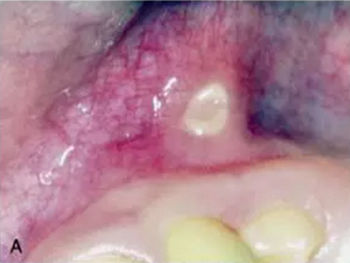 原創(chuàng) |利用半導(dǎo)體激光治療口腔潰瘍 原創(chuàng) |利用半導(dǎo)體激光治療口腔潰瘍