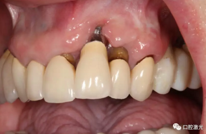 種植體周圍炎的激光療法 種植體周圍炎的激光療法