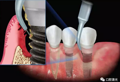 種植體周圍炎的激光療法 種植體周圍炎的激光療法