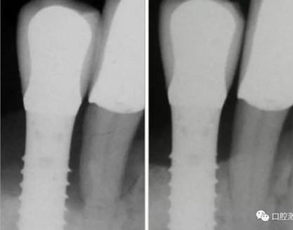 種植體周圍炎的激光療法 種植體周圍炎的激光療法