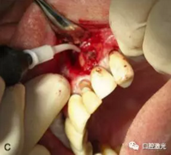 種植體周圍炎的激光療法 種植體周圍炎的激光療法