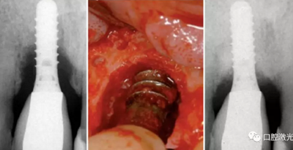 種植體周圍炎的激光療法 種植體周圍炎的激光療法