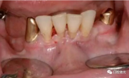 種植醫(yī)生如何用好口腔激光 種植醫(yī)生如何用好口腔激光