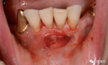 種植醫(yī)生如何用好口腔激光 種植醫(yī)生如何用好口腔激光