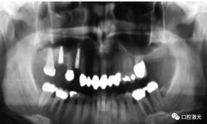 種植醫(yī)生如何用好口腔激光 種植醫(yī)生如何用好口腔激光