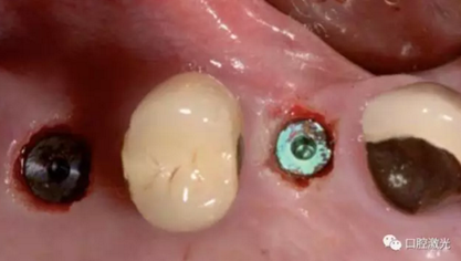 種植醫(yī)生如何用好口腔激光 種植醫(yī)生如何用好口腔激光