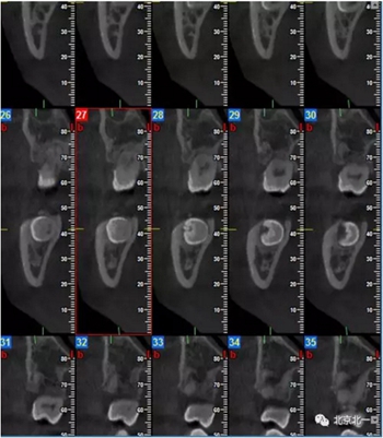 多學(xué)科病例分析---正畸、種植、微創(chuàng)拔牙多學(xué)科交叉病例