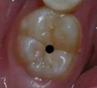 當(dāng)心“腹黑”齲齒，牙齒有個小洞也要補(bǔ)！